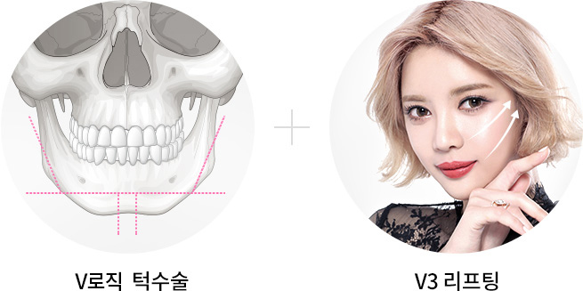 양악 후 코성형