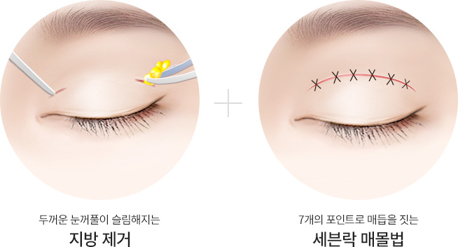 슬림절개법