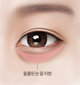 눈밑지방제거