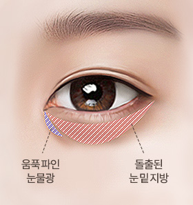 중년 눈밑지방 재배치