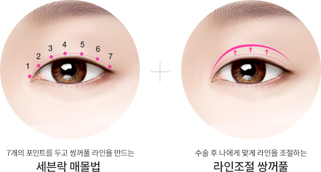 라인조절 세븐락 매몰법
