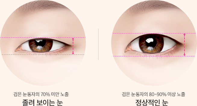 슬림절개법