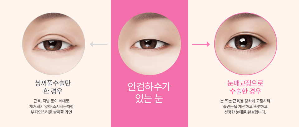 슬림절개법