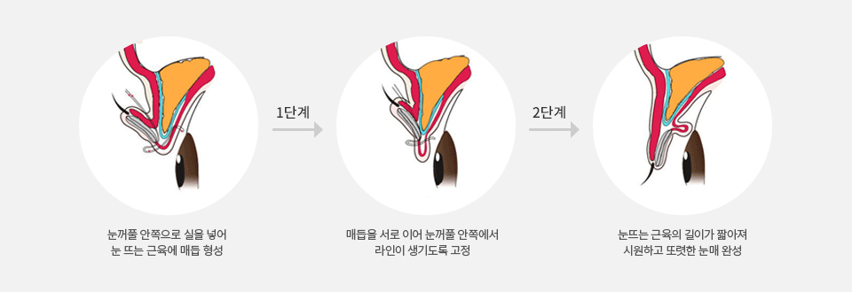 슬림절개법