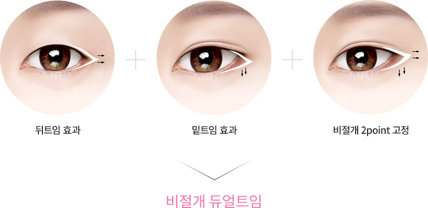 비절개 듀얼트임