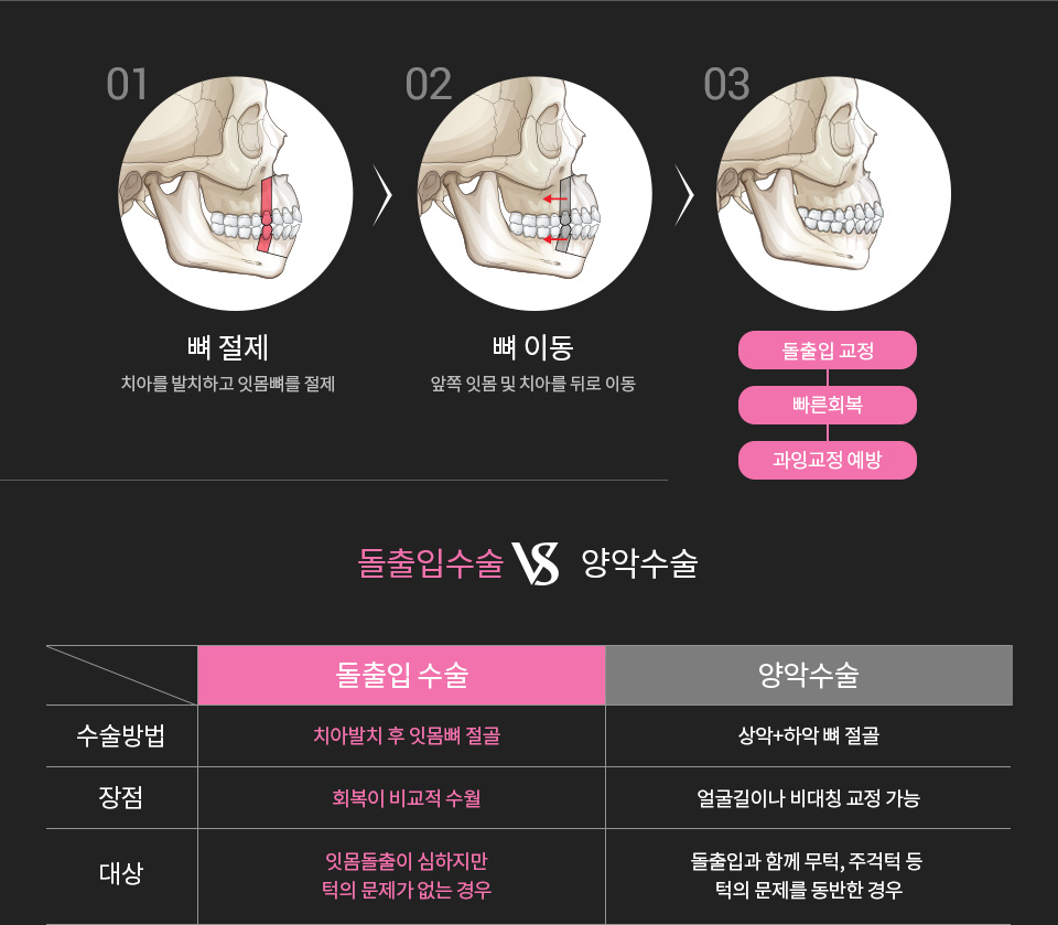 id 돌출입수술