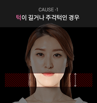 cause-1 턱이 길거나 주걱턱인 경우