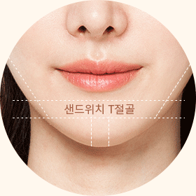 샌드위치T절골로 주걱턱도 디자인