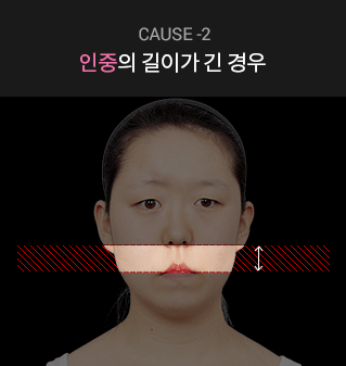 cause-2 인중의 길이가 긴 경우