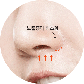 샌드위치T절골로 주걱턱도 디자인
