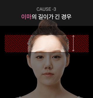 cause-3 이마의 길이가 긴 경우