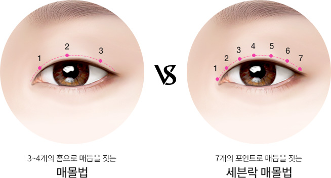 세븐락 매몰법
