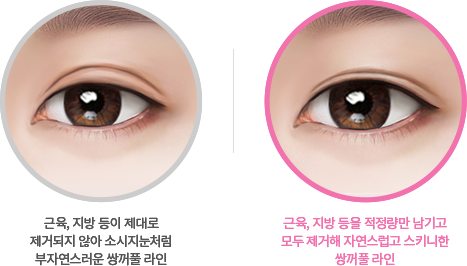 라인조절 세븐락 매몰법